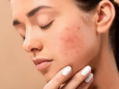 بهترین توصیه برای اینکه جای جوش روی پوست نماند