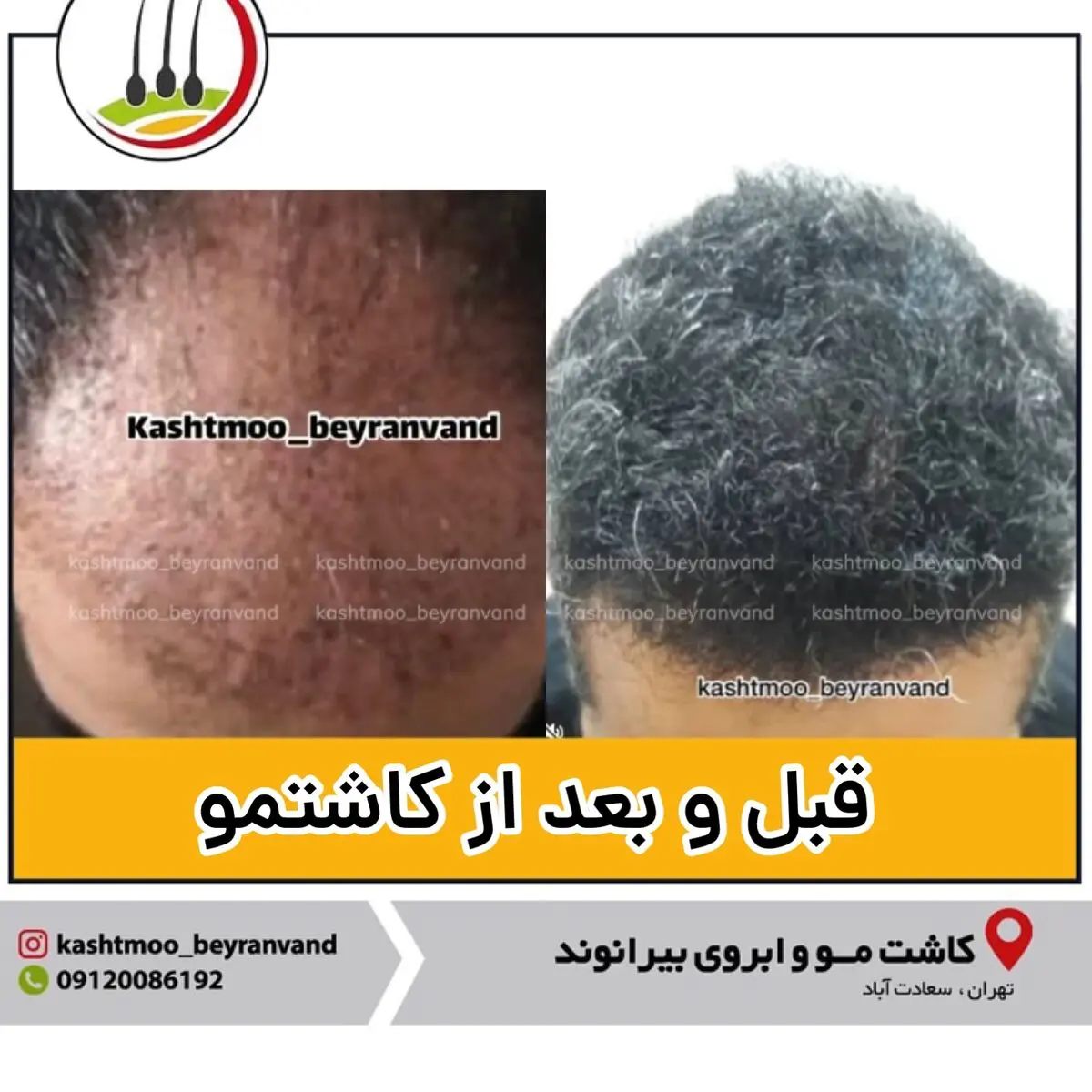جدیدترین روش کاشت مو برای آقایان