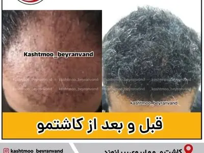 جدیدترین روش کاشت مو برای آقایان