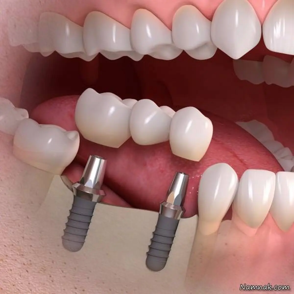 همه چیز درباره کاشت ایمپلنت دندان 