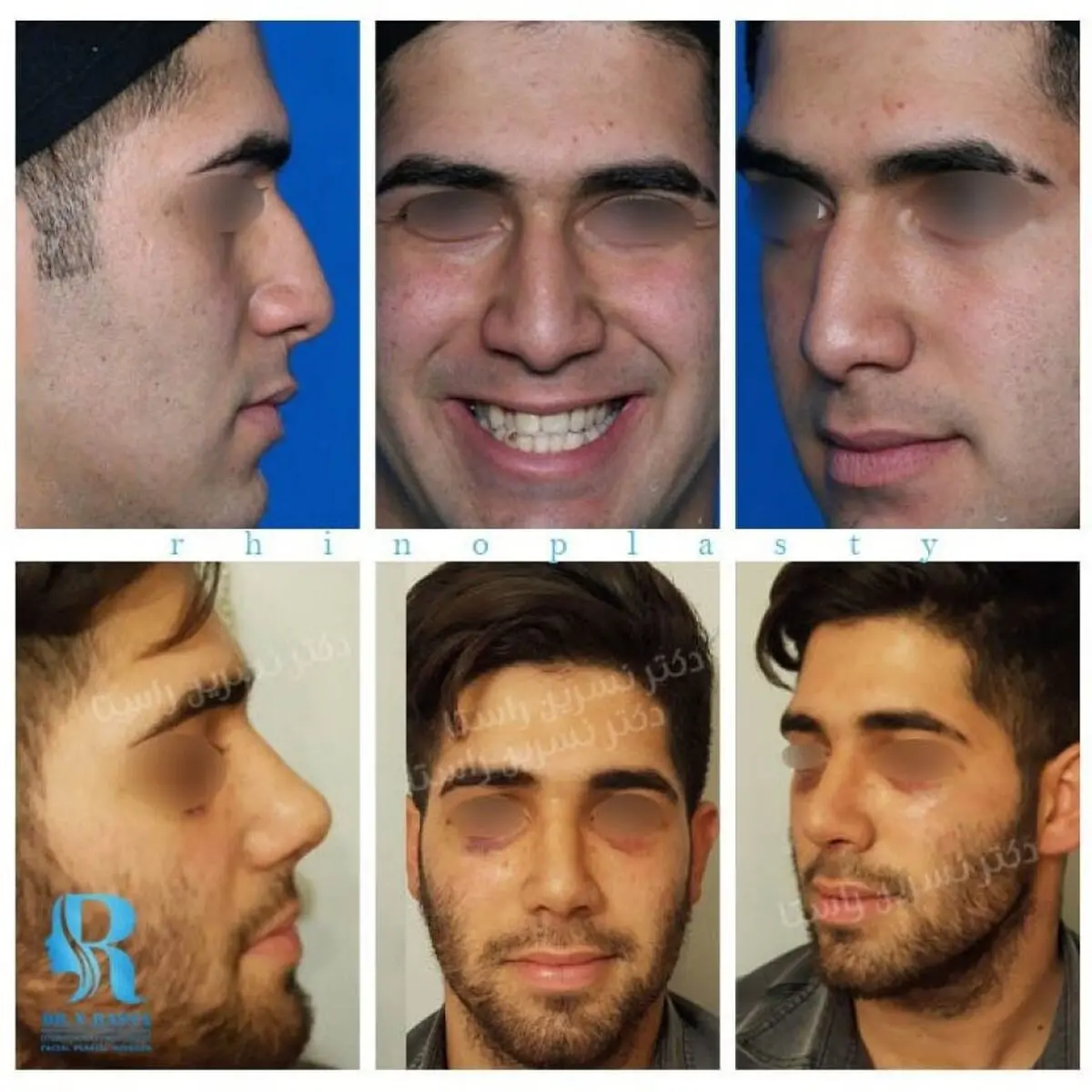 نکاتی در رابطه جراحی زیبایی بینی 