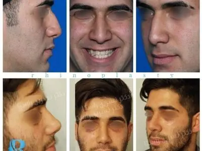 نکاتی در رابطه جراحی زیبایی بینی 
