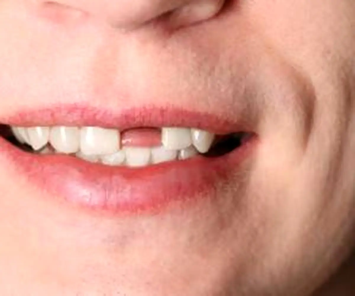 مشکلات جای خالی دندان و فاصله ایجاد شده بین دندان ها