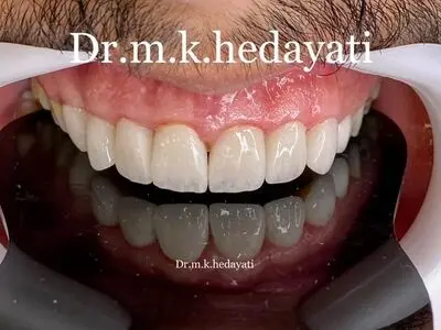 فرق لمینت سرامیکی و ونیر کامپوزیت چیست؟