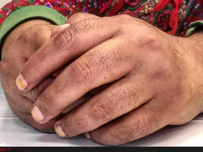 نوزاد چند روزه‌ام را ۵ میلیون تومان فروختم/یکی از بچه‌هایم از خماری و نبود شیرخشک مُرد