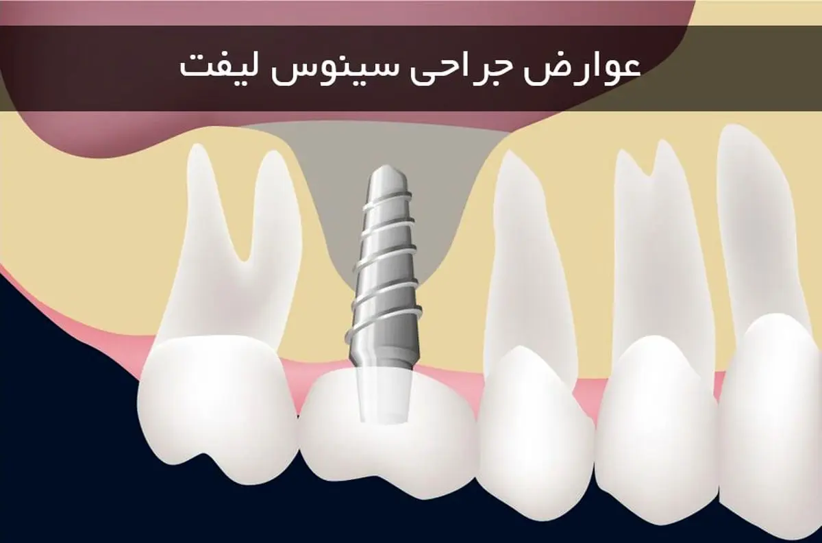 بررسی مهمترین عوارض جراحی سینوس لیفت