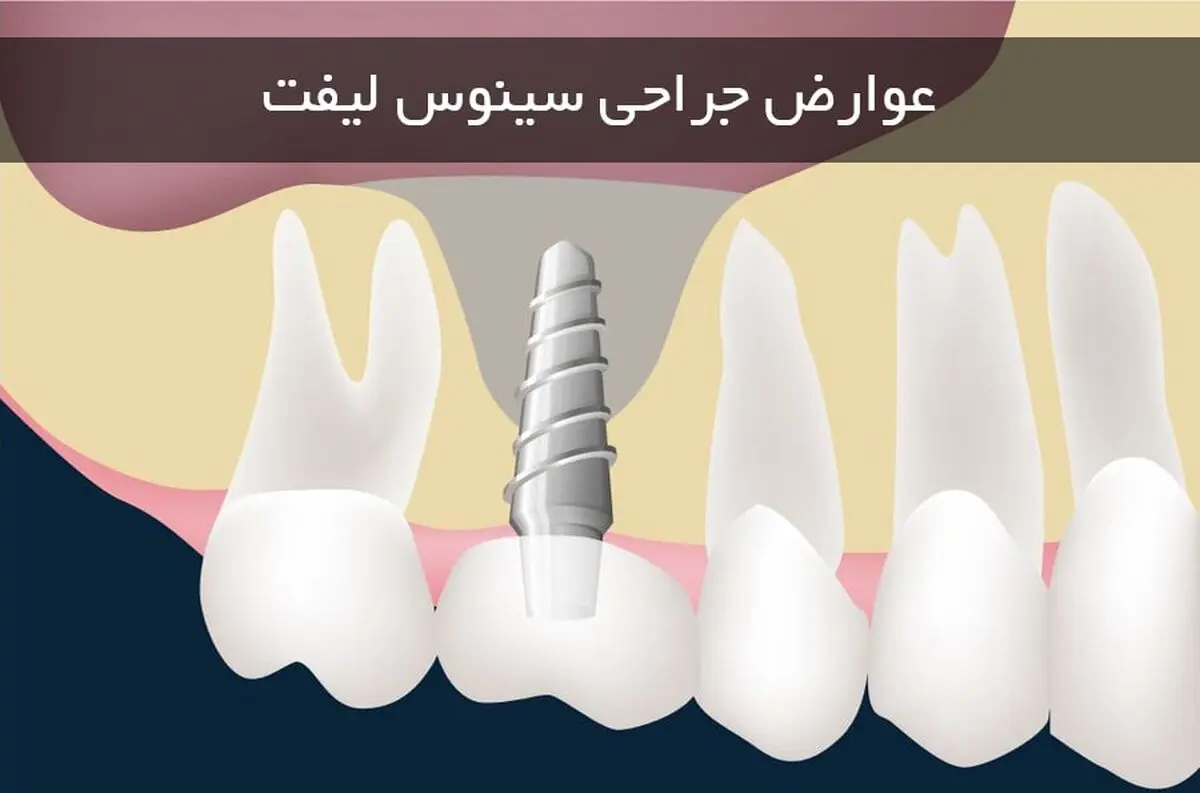 بررسی مهمترین عوارض جراحی سینوس لیفت 
