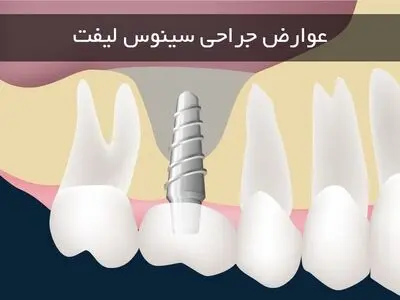 بررسی مهمترین عوارض جراحی سینوس لیفت 