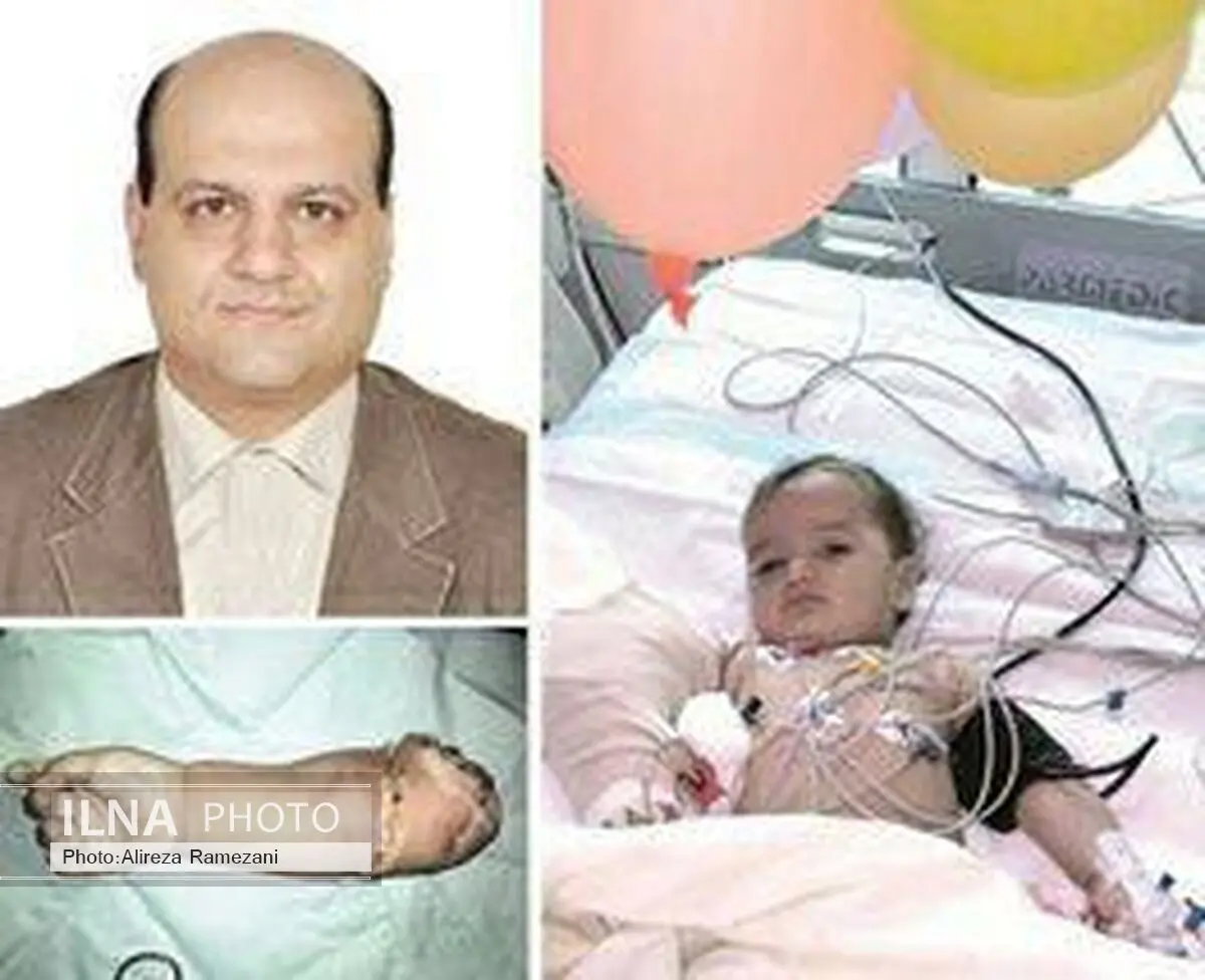 پیوند موفقیت آمیز دست قطع شده کودک ۱۳ماهه در شیراز