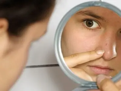 دلیل اصلی جوش زدن بعد از خوردن شکلات