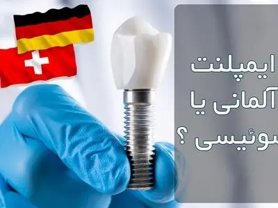 ایمپلنت آلمانی یا سوئیسی ؟ کدام بهتر است؟