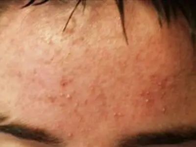 آکنه برای پوست مفید است!
