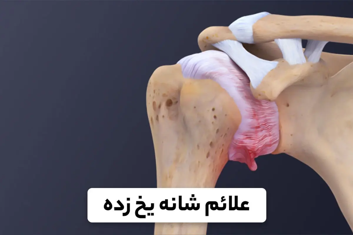 اهمیت بررسی ابتلا به بیماری های زمینه ای در سندروم شانه یخ زده