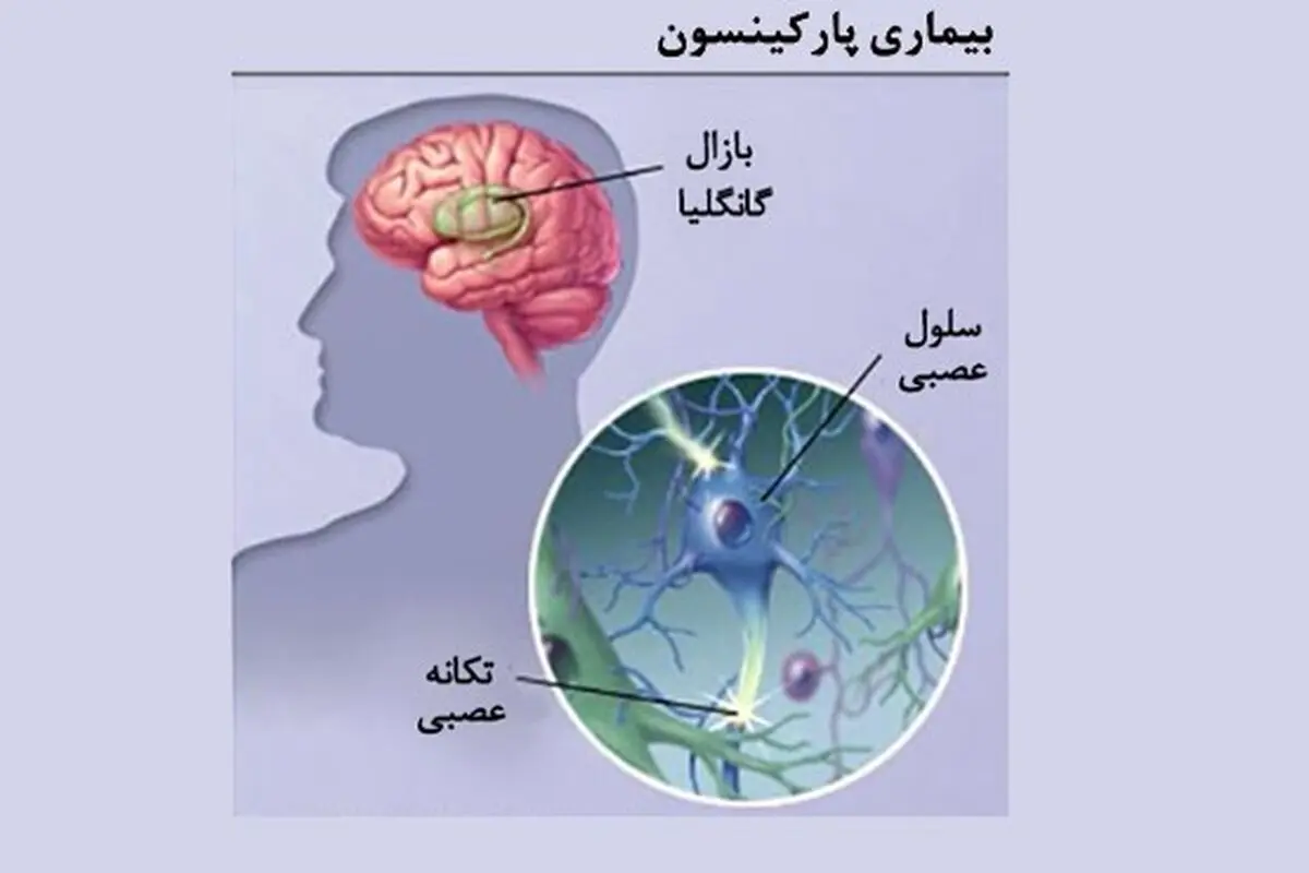 نشانه‌های بیماری پارکینسون 