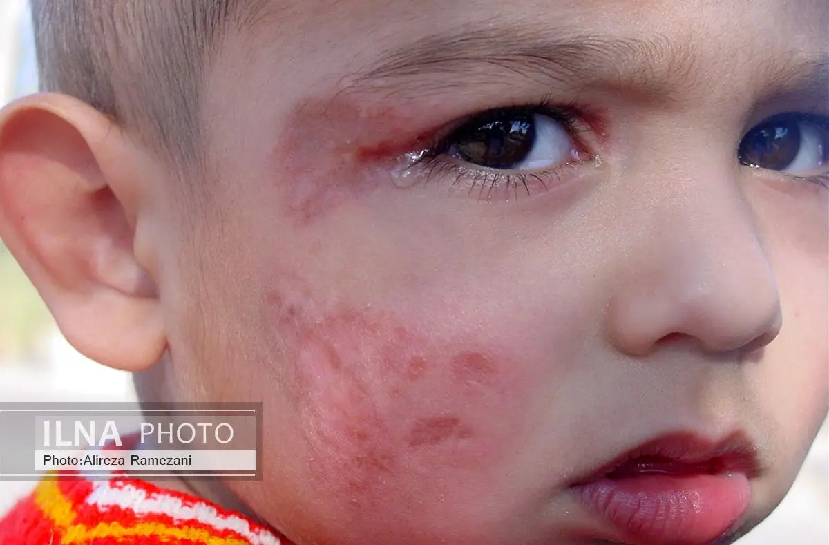 افرایش ابتلا به سالک در جرقویه و شرق اصفهان