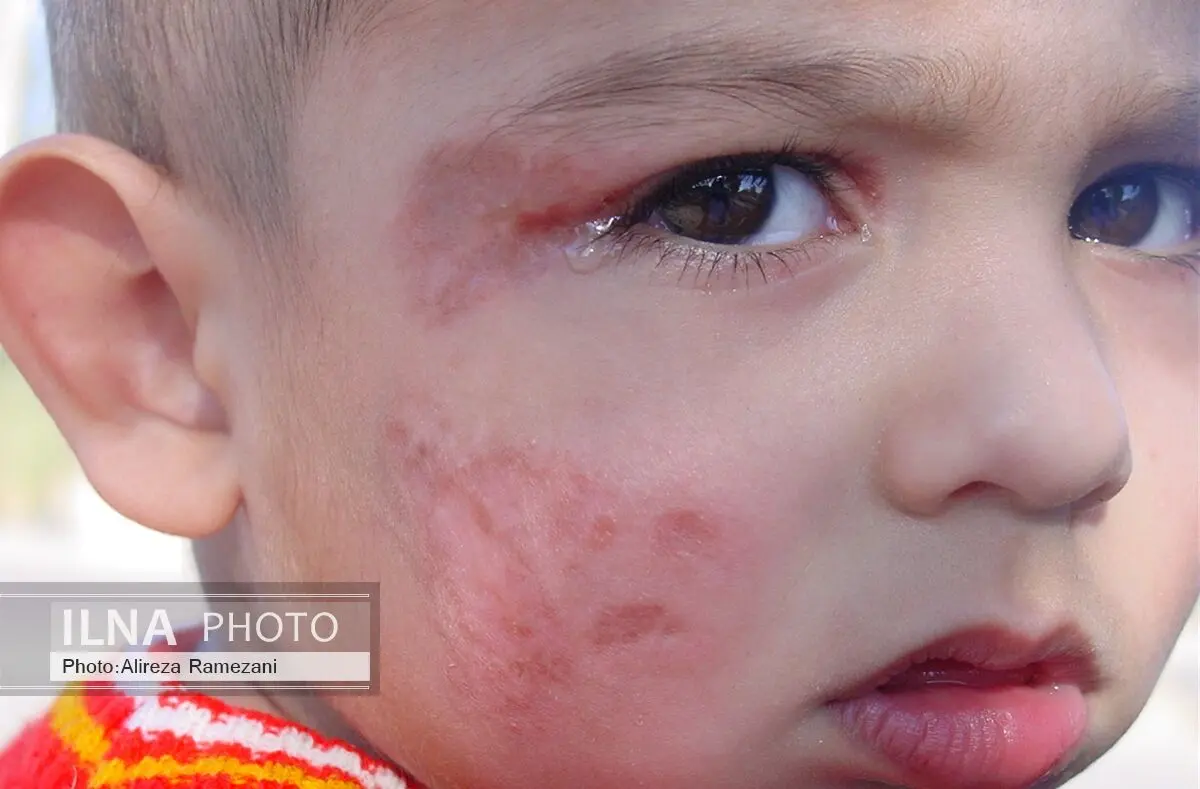افرایش ابتلا به سالک در جرقویه و شرق اصفهان 