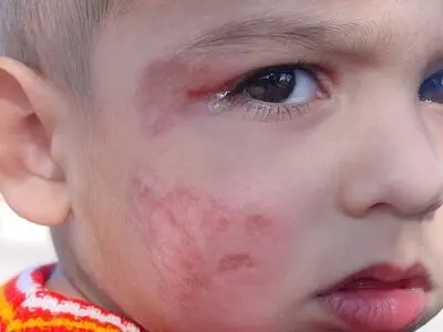 افرایش ابتلا به سالک در جرقویه و شرق اصفهان 