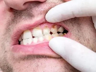 10 عامل مهم که خطر پوسیدگی دندان را افزایش می‌دهد