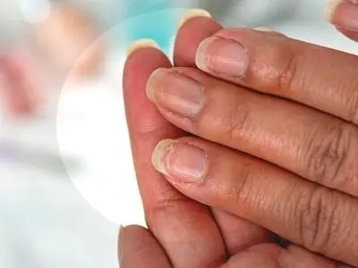 این ۷ نشانه در ناخن یعنی کلسترول شما بالا رفته است