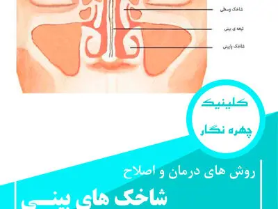 درمان شاخک و شکستگی قبل از جراحی بینی عروسکی