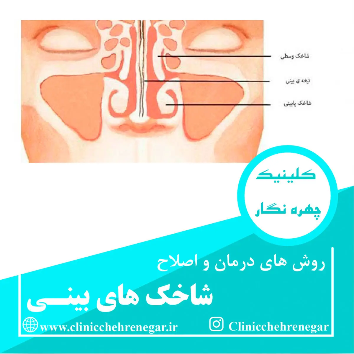 درمان شاخک و شکستگی قبل از جراحی بینی عروسکی