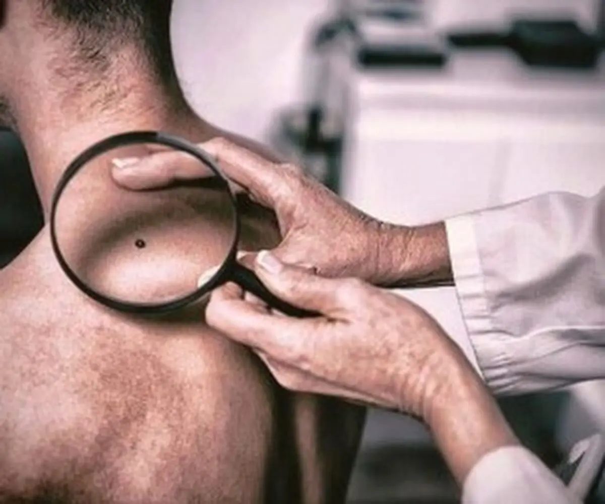 خال های سرطانی؛ با دیدن این نشانه ها به پزشک مراجعه کنید