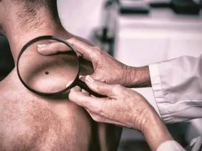 خال های سرطانی؛ با دیدن این نشانه ها به پزشک مراجعه کنید