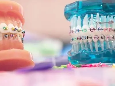 چرا ارتودنسی ثابت کارآمدترین و ارزان‌ترین روش ارتودنسی است؟