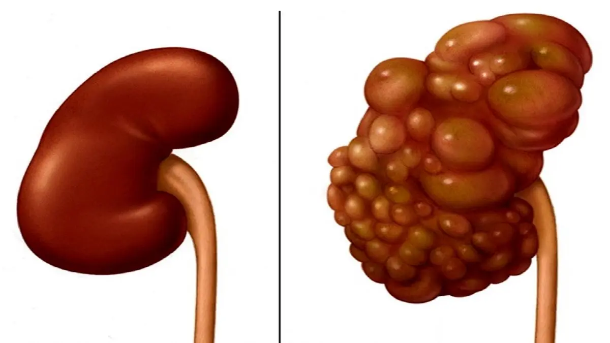 نحوه تشخیص ابتلا به کیست کلیه 