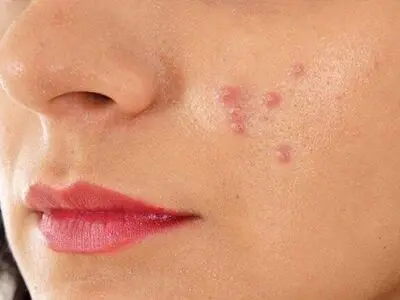 از ارتباط بین آکنه‌های پوستی با قند و شکر چه می‌دانید؟
