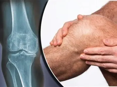   5  پرسش و پاسخ مهم درباره سلامت مفاصل زانو
