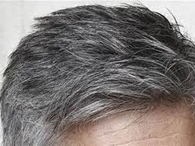 کمبود چه ماده ی غذایی در بدن باعث سفید شدن موها می شود؟