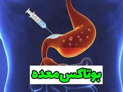 بوتاکس معده چیست؟