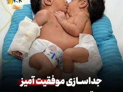 جداسازی مو‌فقیت‌آمیز دوقلو‌های بهم چسبیده