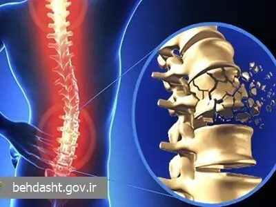 تصادفات، مهمترین عامل آسیب های نخاعی