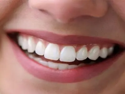 علت بوجود آمدن لکه‌های سفید روی دندان چیست؟
