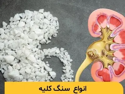 علائم، درمان و باورهای غلط درباره سنگ کلیه