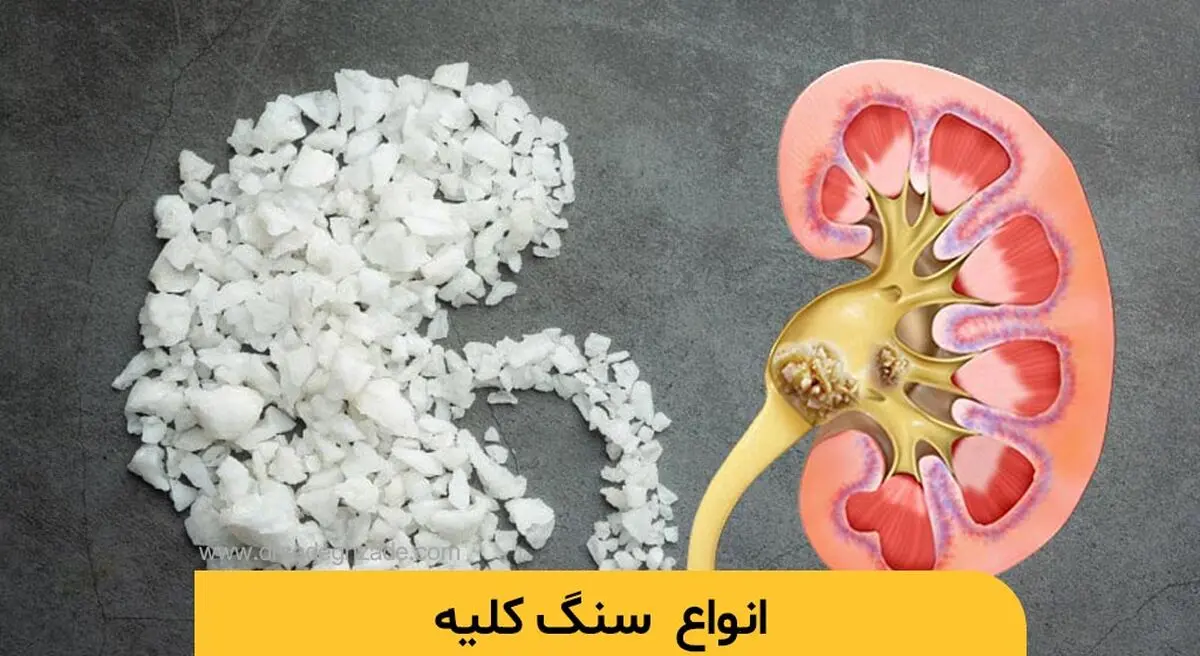 علائم، درمان و باورهای غلط درباره سنگ کلیه