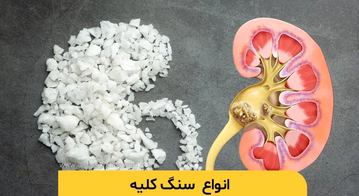 علائم، درمان و باورهای غلط درباره سنگ کلیه