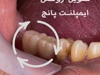 ایمپلنت دیجیتال