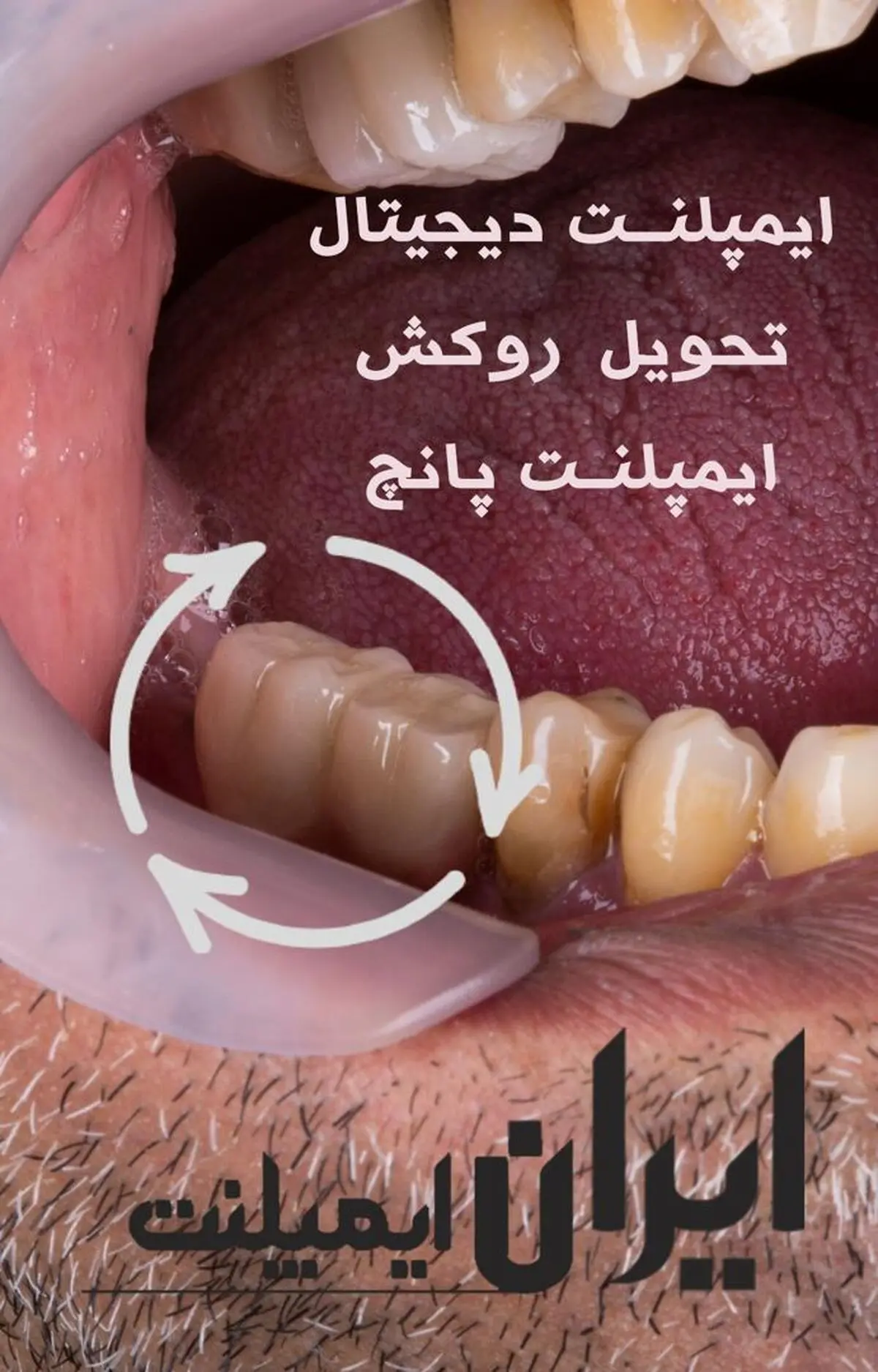 ایمپلنت دیجیتال