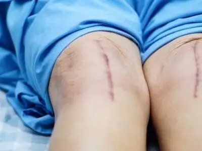 مدت زمان بهبودی کامل بعد از عمل تعویض مفصل زانو + 10 راهکار مراقبتی
