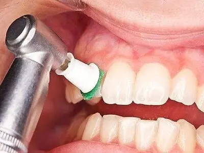 راهکار پیشگیری از تشکیل جرم دندان