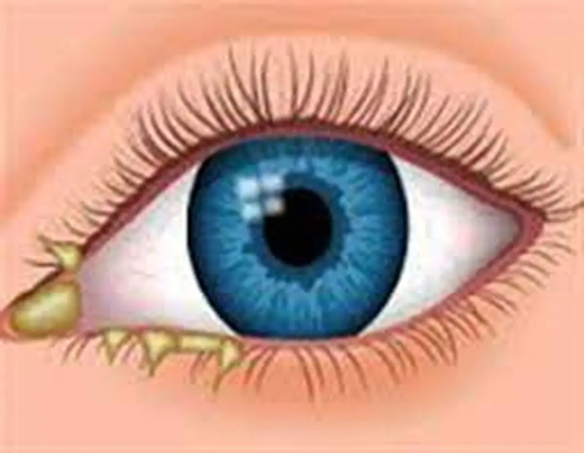مهم ترین علت قی کردن چشم ها چیست؟