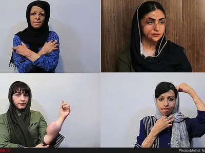 ۳۶۰ عمل جراحیِ بی‌نتیجه روی۱۲ دختر/ مقاومت مسوولان برای درمان در خارج از کشور
