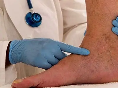 چرا تشخیص واریس اهمیت دارد؟