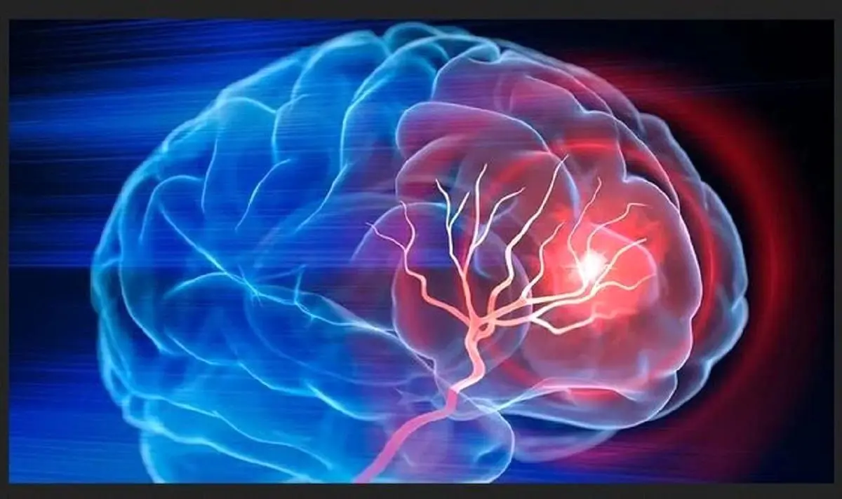 میگرن شایع ترین نوع سردرد/ شیوع آلزایمر در کشور رو به افزایش است
