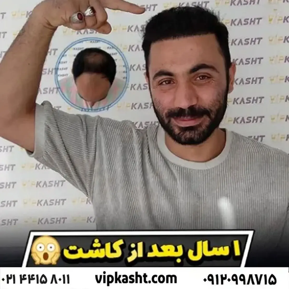 بهترین الگوی طاسی برای کاشت مو