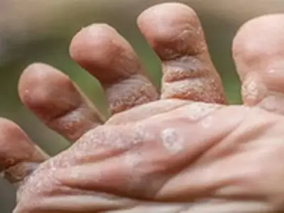 ۱۰ علت پوسته‌پوسته شدن پا