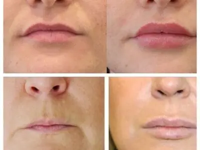 مهمترین نکات درباره تفاوت تزریق چربی و تزریق ژل